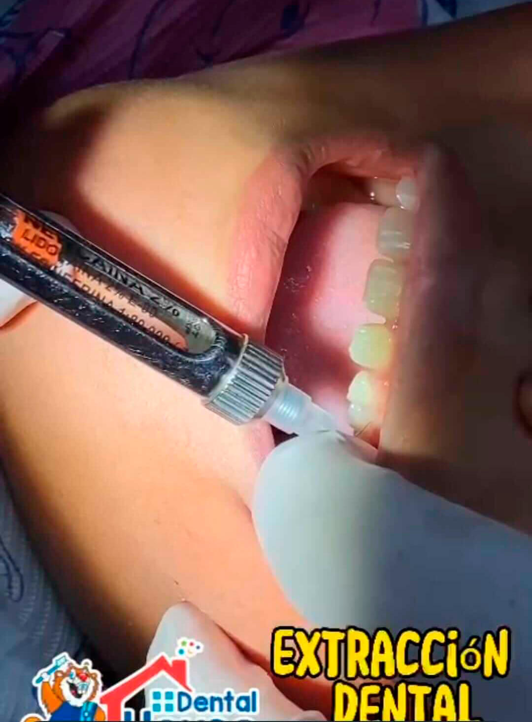 Odontopiatria--Extraccion-dental